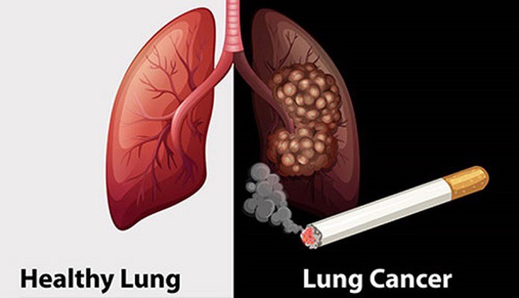 Mắc ung thư phổi do 'hít' phải khói thuốc lá thụ động trong gia đình- Ảnh 1.