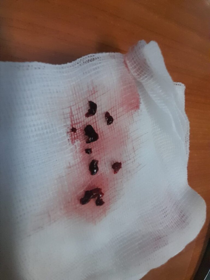 Đang ăn cơm trưa, người đàn ông đột ngột xuất hiện méo miệng, liệt nửa người phải- Ảnh 2.