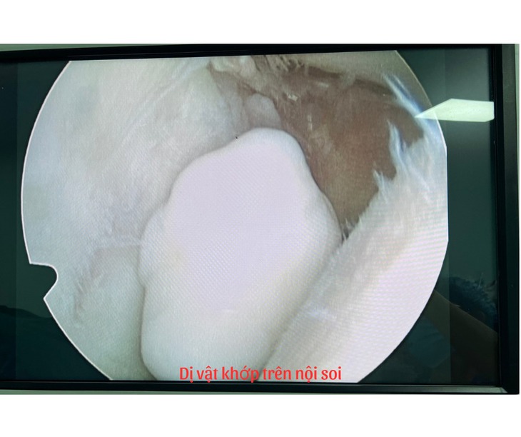 Tá hỏa lấy ra 40 khối u sụn trong khớp vai nữ thanh niên- Ảnh 6. Tá hỏa lấy ra 40 khối u sụn trong khớp vai nữ thanh niên- Ảnh 6.