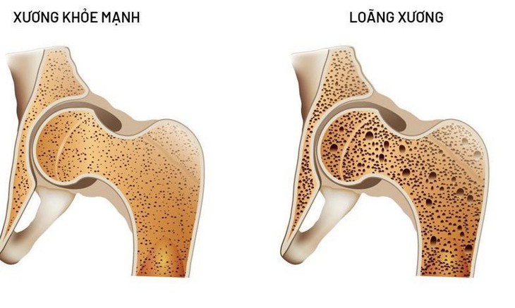 Những thực phẩm chứa chất dinh dưỡng đặc biệt giúp ngăn ngừa loãng xương - Ảnh 1.