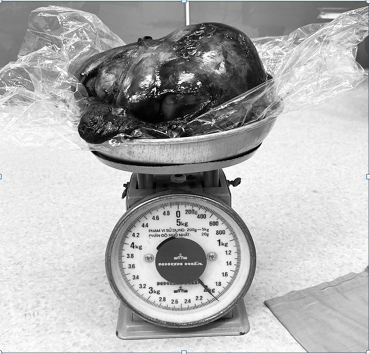Bác sĩ cân não phẫu thuật lấy khối u phổi nặng hơn 2kg chiếm hầu hết thể tích lồng ngực, cấu trúc phức tạp- Ảnh 2. Bác sĩ cân não phẫu thuật lấy khối u phổi nặng hơn 2kg chiếm hầu hết thể tích lồng ngực, cấu trúc phức tạp- Ảnh 2.