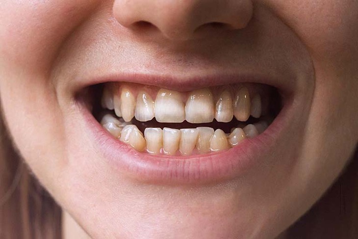 Chuyên gia dinh dưỡng cảnh báo 9 tác hại của giấm táo khi uống quá nhiều- Ảnh 3. Chuyên gia dinh dưỡng cảnh báo 9 tác hại của giấm táo khi uống quá nhiều- Ảnh 3.
