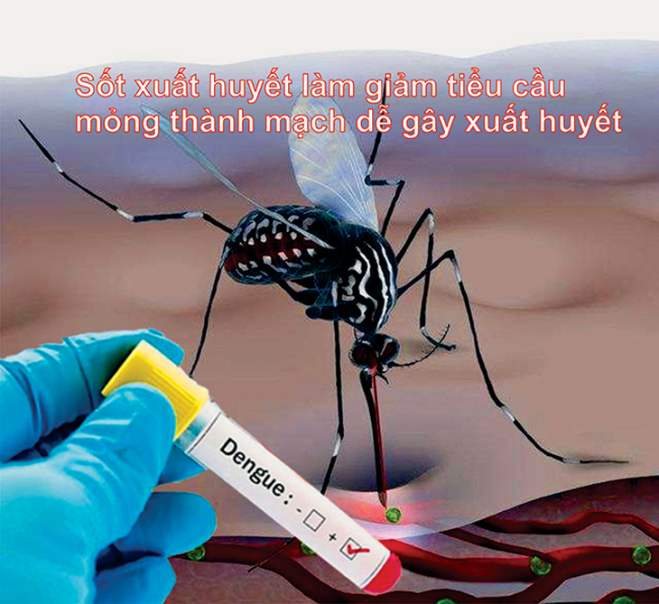 Giảm tiểu cầu, rụng tóc khi bị sốt xuất huyết nên bổ sung gì?- Ảnh 1.