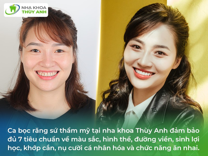 7 tiêu chuẩn "vàng" cho nụ cười đẹp sau bọc sứ- Ảnh 2.