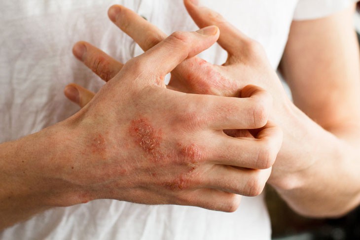 Mùa đông, thời tiết lạnh, hanh khô làm tăng tỉ lệ bệnh nhân mắc các bệnh về da đó là khô da, nứt nẻ chân tay, mẩn ngứa, mề đay… Ảnh minh hoạ