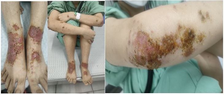Nhiễm khuẩn, phù nề, tiết dịch vì nghe hàng xóm mách dùng thuốc nam- Ảnh 2. Nhiễm khuẩn, phù nề, tiết dịch vì nghe hàng xóm mách dùng thuốc nam- Ảnh 2.