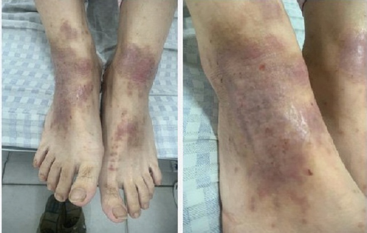 Nhiễm khuẩn, phù nề, tiết dịch vì nghe hàng xóm mách dùng thuốc nam- Ảnh 3. Nhiễm khuẩn, phù nề, tiết dịch vì nghe hàng xóm mách dùng thuốc nam- Ảnh 3.