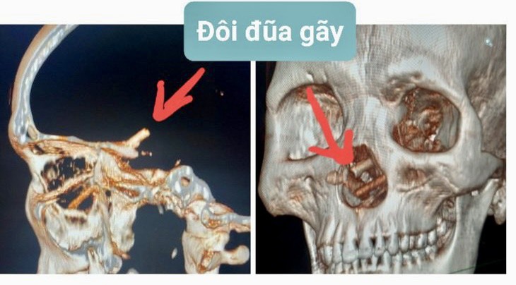 Hi hữu đôi đũa đâm xuyên từ mũi vào não 5 tháng mới phát hiện- Ảnh 1. Hi hữu đôi đũa đâm xuyên từ mũi vào não 5 tháng mới phát hiện- Ảnh 1.