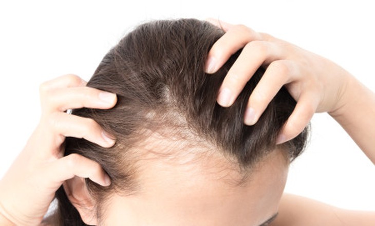 Rụng tóc nhiều sau sốt xuất huyết nên ăn gì để phục hồi?- Ảnh 1.