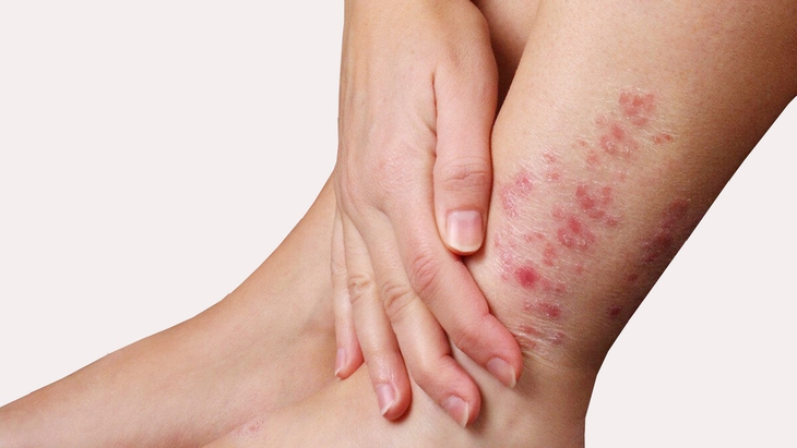 Kháng thuốc chống nấm mối đe dọa mới với sức khoẻ cộng đồng- Ảnh 1.