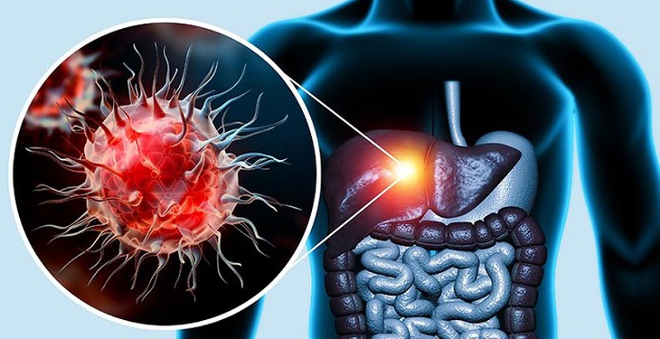 3 điều cần biết về ung thư gan- Ảnh 1.