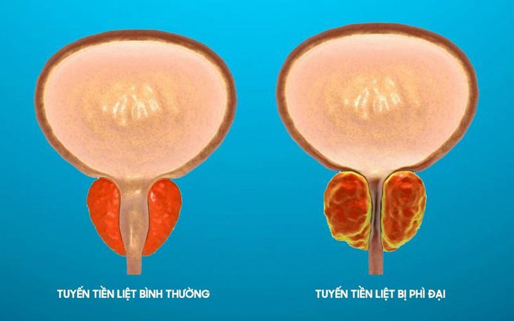 Tiểu đêm nhiều lần: Biểu hiện của phì đại tiền liệt tuyến- Ảnh 1.