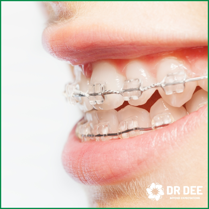 Nên chọn niềng răng mắc cài kim loại hay sứ?- Ảnh 2. Nên chọn niềng răng mắc cài kim loại hay sứ?- Ảnh 2.
