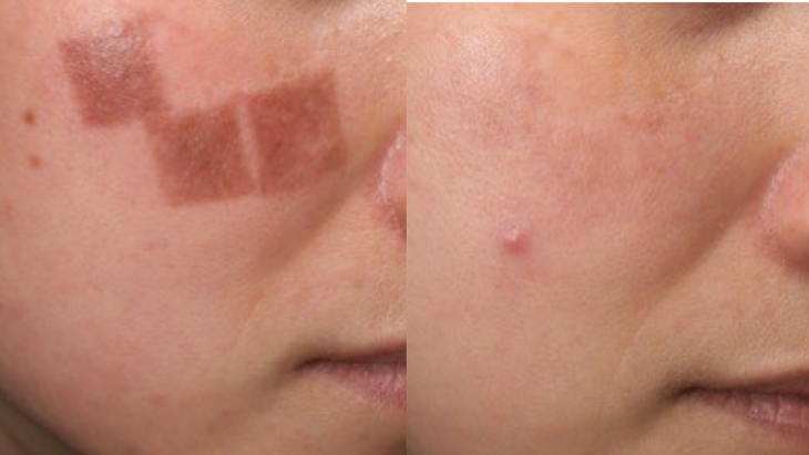 Phòng khám da liễu chi 50 tỷ đầu tư công nghệ cao vào trị nám – trẻ hóa- Ảnh 2. Phòng khám da liễu chi 50 tỷ đầu tư công nghệ cao vào trị nám – trẻ hóa- Ảnh 2.