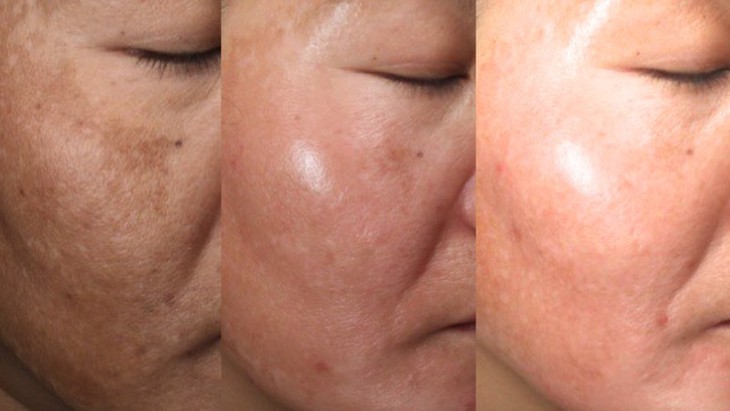 Phòng khám da liễu chi 50 tỷ đầu tư công nghệ cao vào trị nám – trẻ hóa- Ảnh 3. Phòng khám da liễu chi 50 tỷ đầu tư công nghệ cao vào trị nám – trẻ hóa- Ảnh 3.