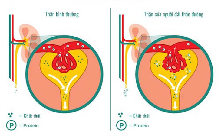 Đường máu cao ảnh hưởng thế nào đến thận?- Ảnh 1.
