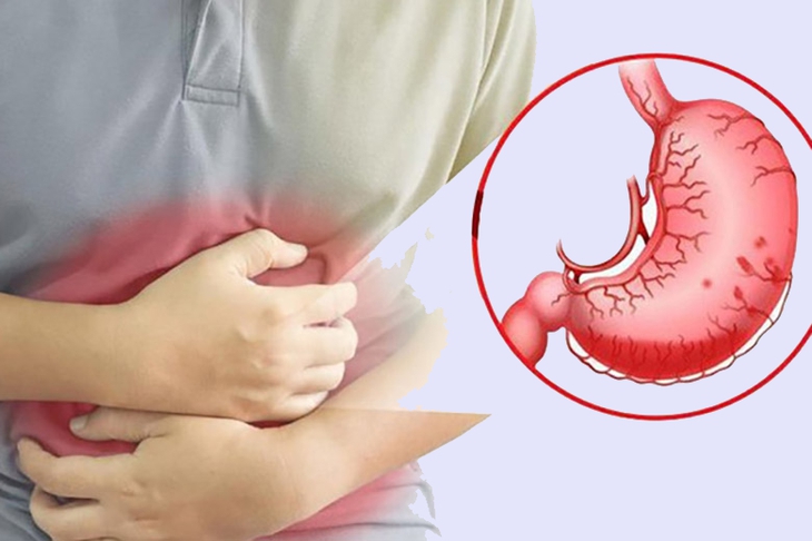 Hãy thận trọng khi tiếp xúc với những người nhiễm vi khuẩn HP. Ảnh minh họa