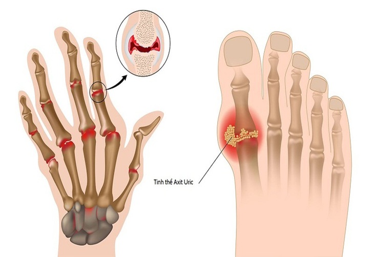 Acid uric máu tăng cao là mối nguy hiểm cho sức khỏe, liên quan mật thiết của những cơn đau dữ dội cho người bị bệnh gout.