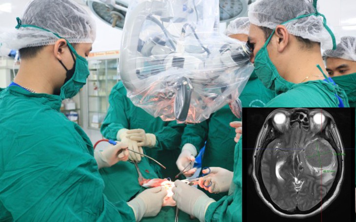 Đau đầu nhiều ngày, bệnh nhân nhập viện với khối u màng não có kích thước khổng lồ