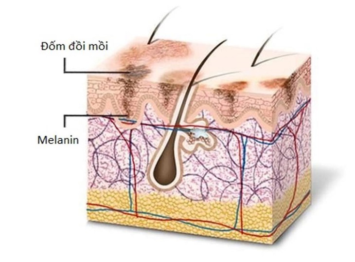 Các liệu pháp trị đồi mồi trên da - Ảnh 1. Các liệu pháp trị đồi mồi trên da - Ảnh 1.