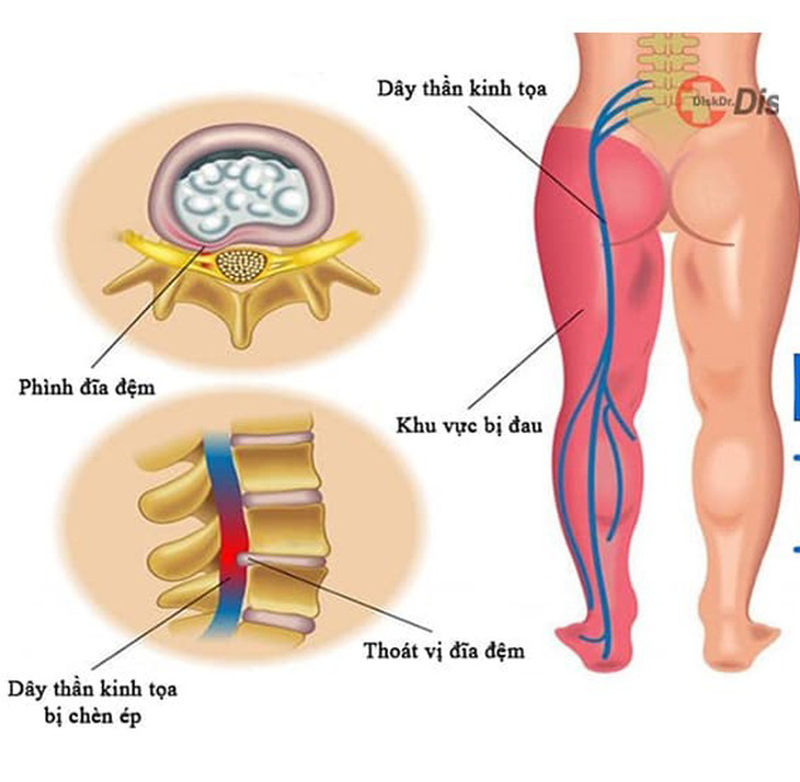 Đau thần kinh tọa có nên đi bộ không? - Ảnh 1.