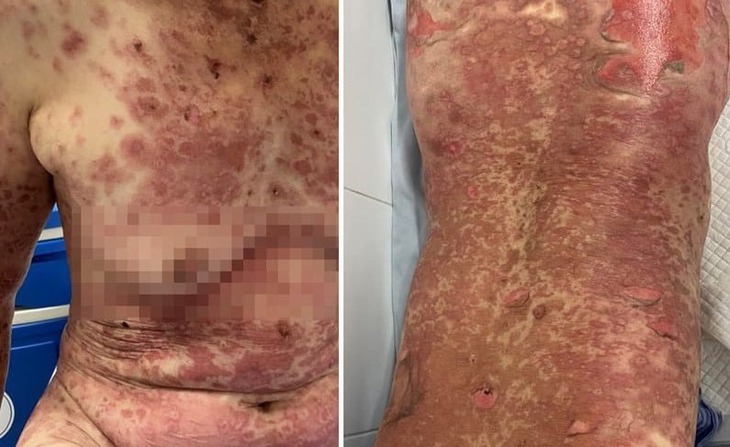 Tự ý dùng thuốc nam điều trị bệnh, nhiều trường bị dị ứng nặng - Ảnh 2.