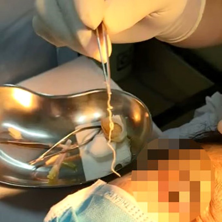 Phát hiện con giun dài 10cm còn sống chui vào mắt người phụ nữ Hải Phòng - Ảnh 1. Phát hiện con giun dài 10cm còn sống chui vào mắt người phụ nữ Hải Phòng - Ảnh 1.