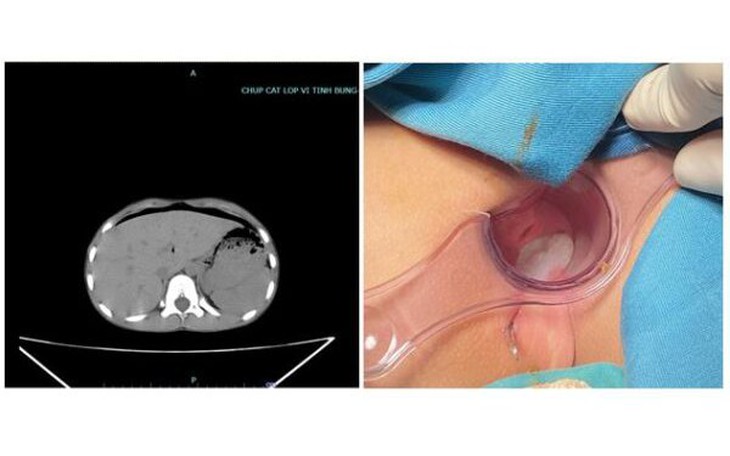 Bé 8 tuổi thủng trực tràng vì ngồi vào chiếc bút do bạn dựng ngược