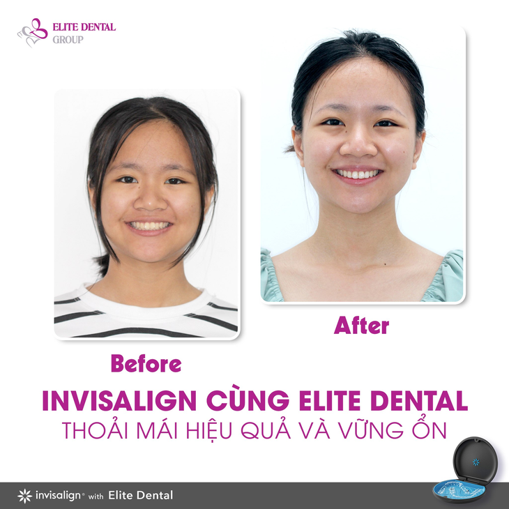 Nguy cơ niềng răng bị hỏng: Cảnh báo đáng lưu ý - Ảnh 3. Nguy cơ niềng răng bị hỏng: Cảnh báo đáng lưu ý - Ảnh 3.