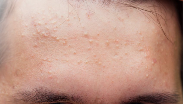 Nổi mụn ẩn trên trán phải làm sao? - Ảnh 1.
