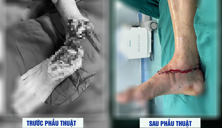 Nối bàn chân bị cắt gần đứt lìa cho người đàn ông gặp tai nạn khi làm cỏ- Ảnh 2.