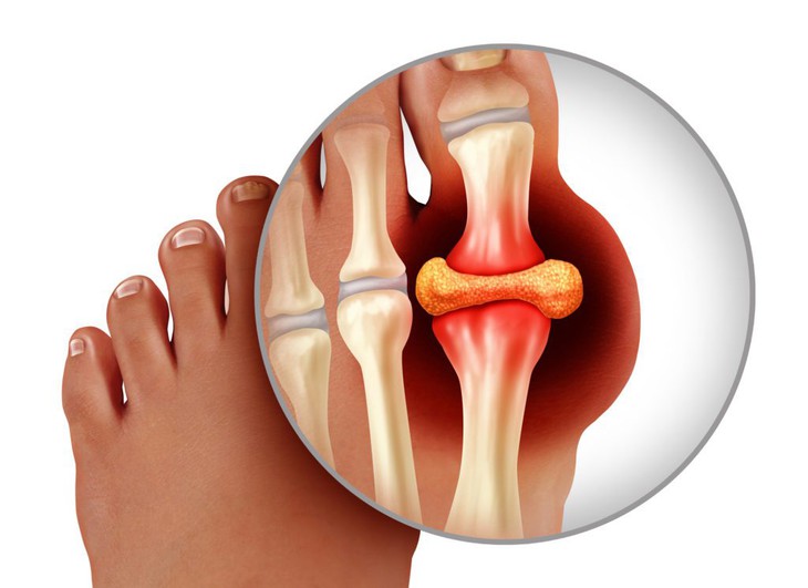 Thực phẩm nào có purine thấp an toàn cho người bệnh gout?- Ảnh 1.
