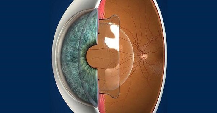 Phương pháp phẫu thuật Phakic với nhiều ưu đãi tại Trung tâm Mắt kỹ thuật cao Bệnh viện Đông Đô- Ảnh 1.