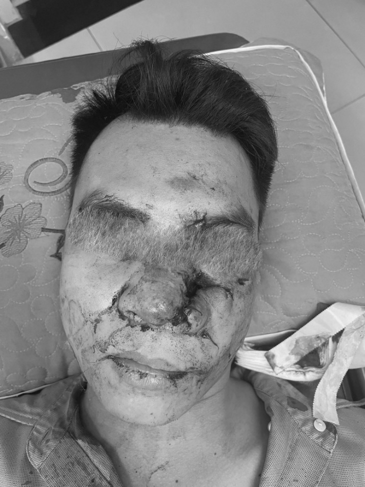 Phục hồi xương vùng mặt vỡ nát cứu thanh niên sau tai nạn- Ảnh 1. Phục hồi xương vùng mặt vỡ nát cứu thanh niên sau tai nạn- Ảnh 1.
