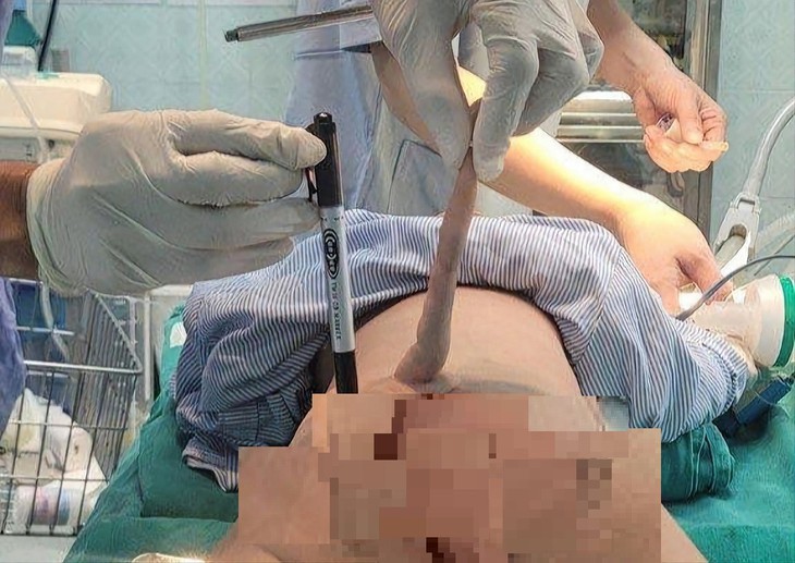 Trẻ sinh ra đã có đuôi dị tật bẩm sinh hiếm gặp, cha mẹ cần làm gì để ngăn ngừa dị tật sơ sinh?- Ảnh 1.