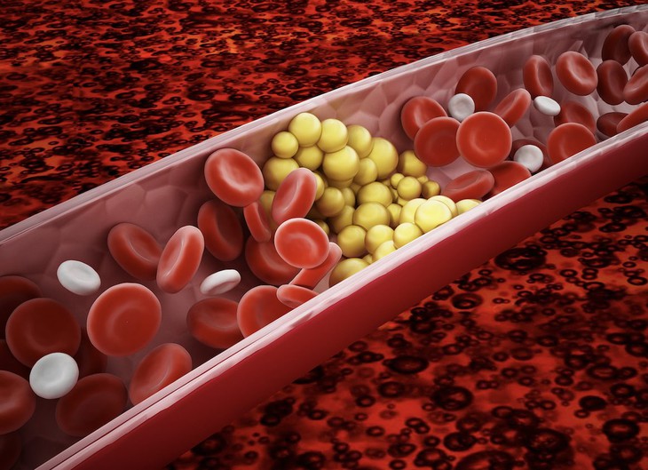 Máu nhiễm mỡ gây lắng đọng cholesterol ở thành động mạch và hình thành mảng xơ vữa, làm hẹp lòng động mạch.