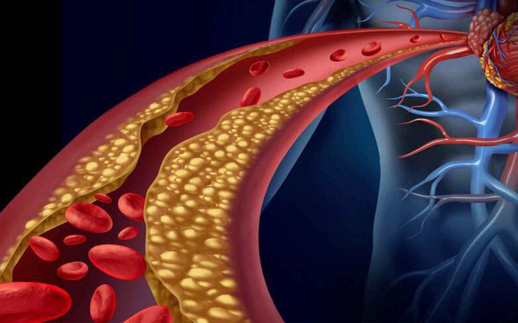 Người bị rối loạn lipid máu cần lưu ý gì?