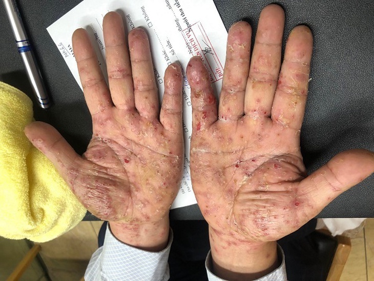 Nghĩ ngứa da do thời tiết, đi khám cả nhà phát hiện mắc ghẻ- Ảnh 1. Nghĩ ngứa da do thời tiết, đi khám cả nhà phát hiện mắc ghẻ- Ảnh 1.