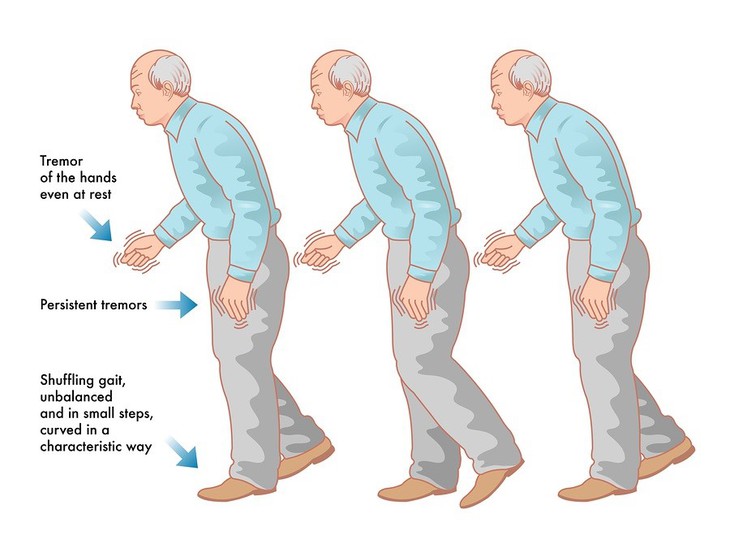 Chẩn đoán phân biệt giữa bệnh Parkinson và hội chứng Parkinson- Ảnh 1. Chẩn đoán phân biệt giữa bệnh Parkinson và hội chứng Parkinson- Ảnh 1.