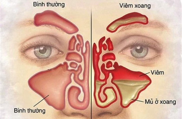 Viêm xoang gây đau đầu cần làm gì?- Ảnh 1. Viêm xoang gây đau đầu cần làm gì?- Ảnh 1.