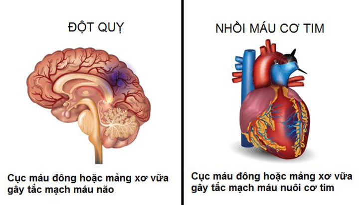 Phân biệt nhồi máu cơ tim và đột quỵ- Ảnh 1.