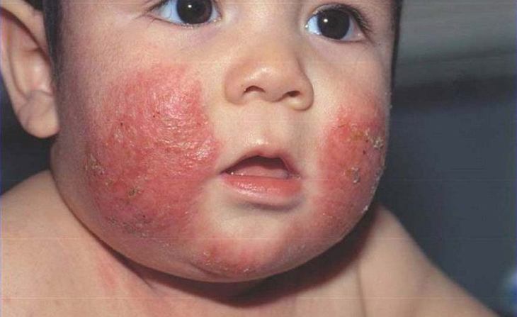 Chàm sữa ở trẻ và những lưu ý khi chọn sản phẩm bôi chàm sữa- Ảnh 2.