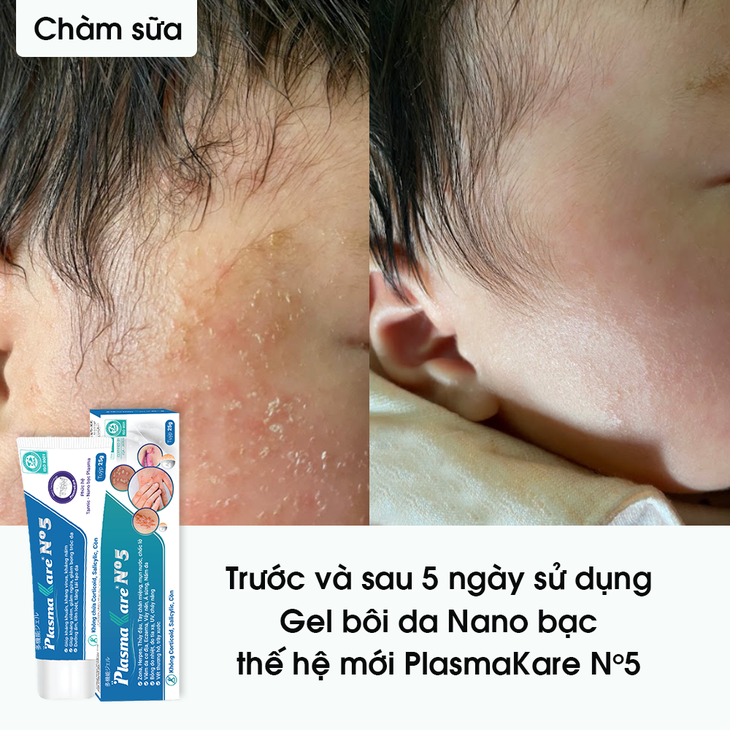 Chàm sữa ở trẻ và những lưu ý khi chọn sản phẩm bôi chàm sữa- Ảnh 4.