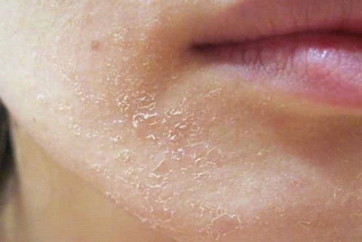 Khi nhiệt độ xuống thấp và độ ẩm giảm mạnh, da của bạn mất nước trở nên khô, ngứa, bong tróc, dễ kích ứng không còn mềm mại, khỏe mạnh… Ảnh minh họa