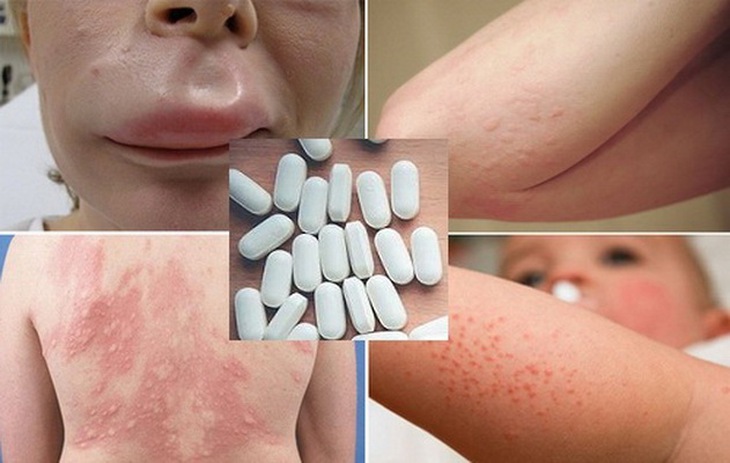 Nhận biết dấu hiệu dị ứng thuốc trên da và cách xử trí- Ảnh 1.