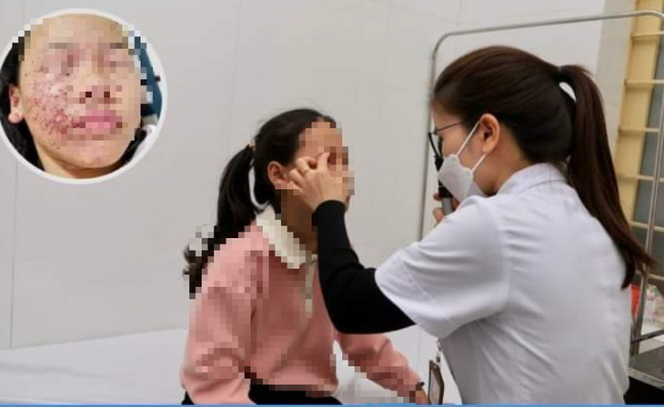 Bé gái tự chế pháo bằng diêm dẫn đến tổn thương 2 mắt, bỏng mặt- Ảnh 1.