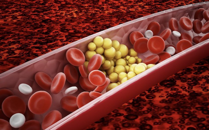 5 lưu ý giúp ngăn ngừa cholesterol cao và phòng tránh đột quỵ- Ảnh 1.
