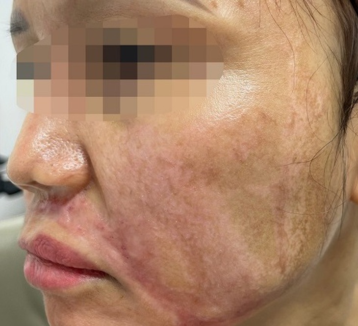 Bỏng nặng trên mặt do điều trị nám da, bác sĩ nói gì?- Ảnh 1.