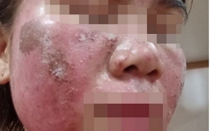 Bỏng nặng trên mặt do điều trị nám da, khuyến cáo từ bác sĩ