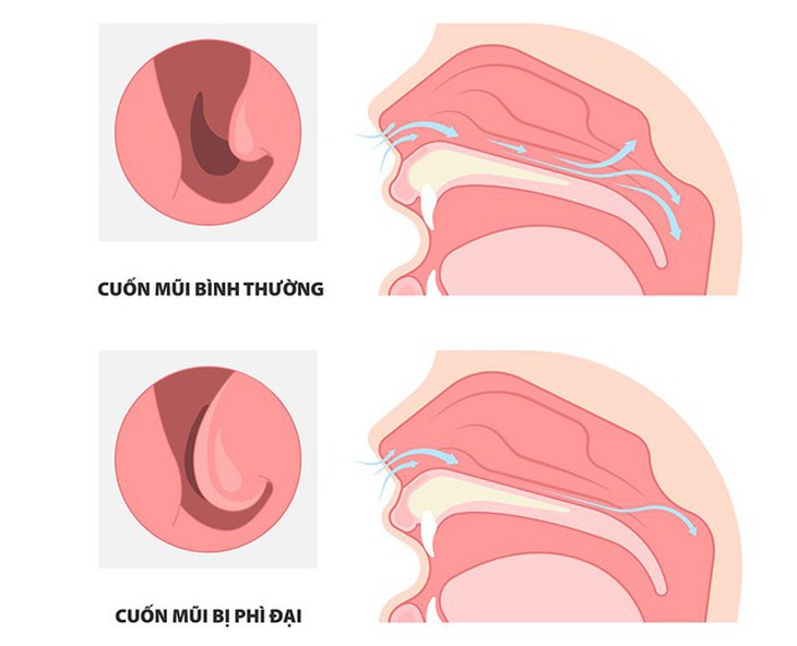Điều trị nghẹt mũi do thuốc thông mũi như thế nào?- Ảnh 1.